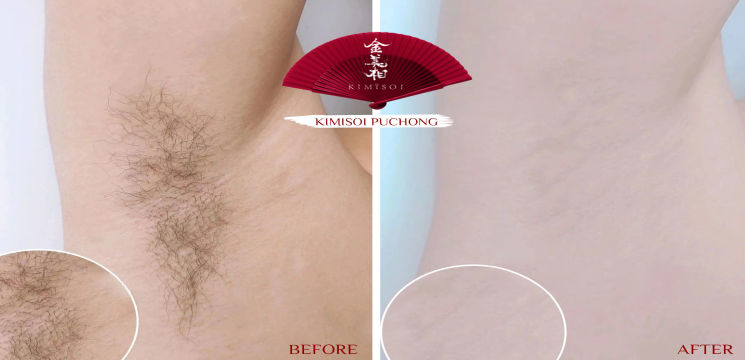 808 Freezing Point Permanent Hair Removal